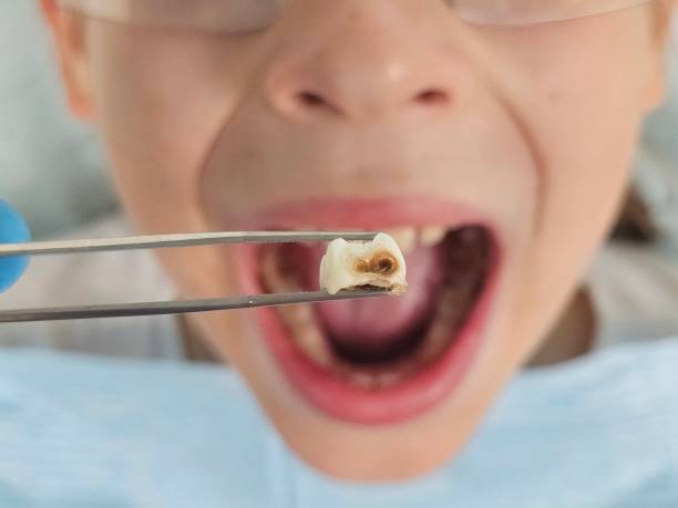 Best Emergency Dental Care for Abscessed Tooth in Dulles Town Center, VA
